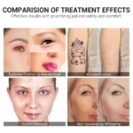 www.hktmay.com_laser tattoo removal_TM-J108_Tingmay Nd Yag Tattoo Removal Laser Machine_Before and After