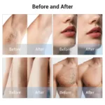 www.hktmay.com_TM-E133_Diode Laser Hair Removal Machine_Before and After Result