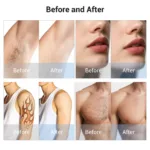 Velofrost 2 in 1 Picosecond Tattoo Laser Removal Machine – Bild 2